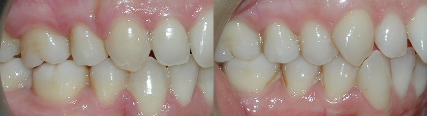 4 Premolar Extraction to Correct Crowding