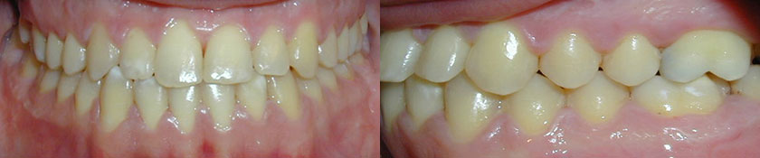 Surgical Maxillary Advancement & Mandibular Setback