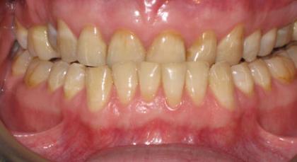 Anterior Cross Bite