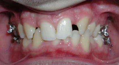 Congenitally Missing Teeth