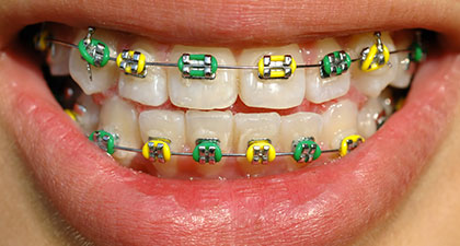 Metal Braces