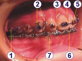 Parts of an orthodontic appliance